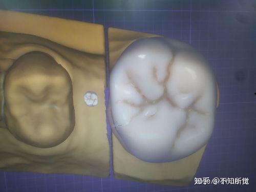 口腔雕牙视频,精湛技艺，重塑微笑之美